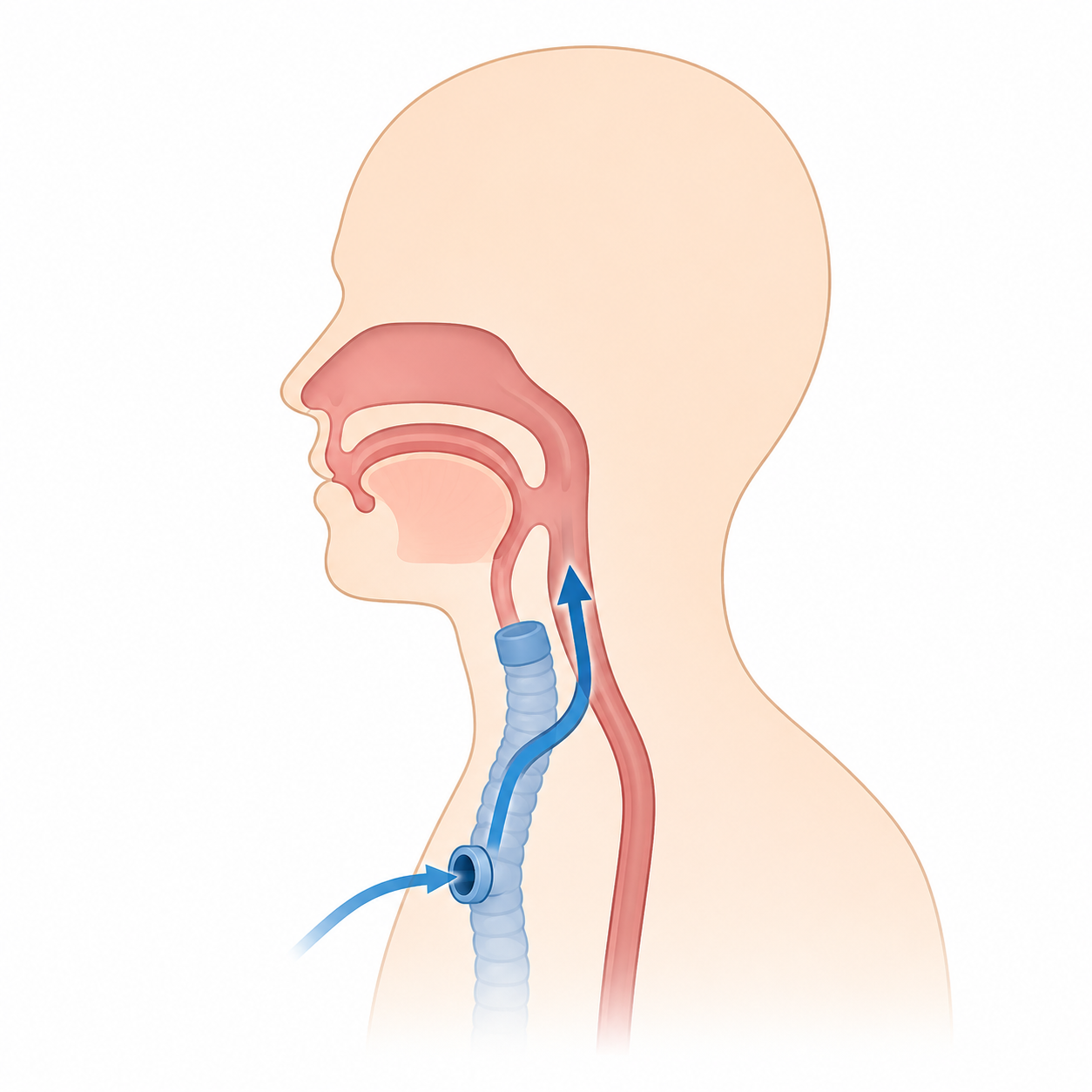 Préparation avant une laryngectomie totale Avant l’opération du larynx
