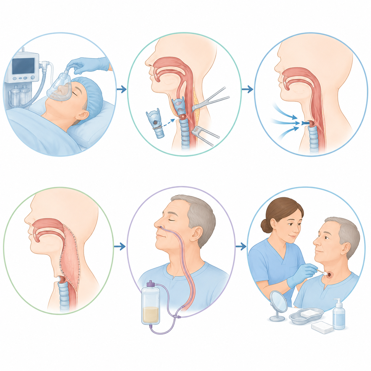 Cancer du larynx laryngectomie