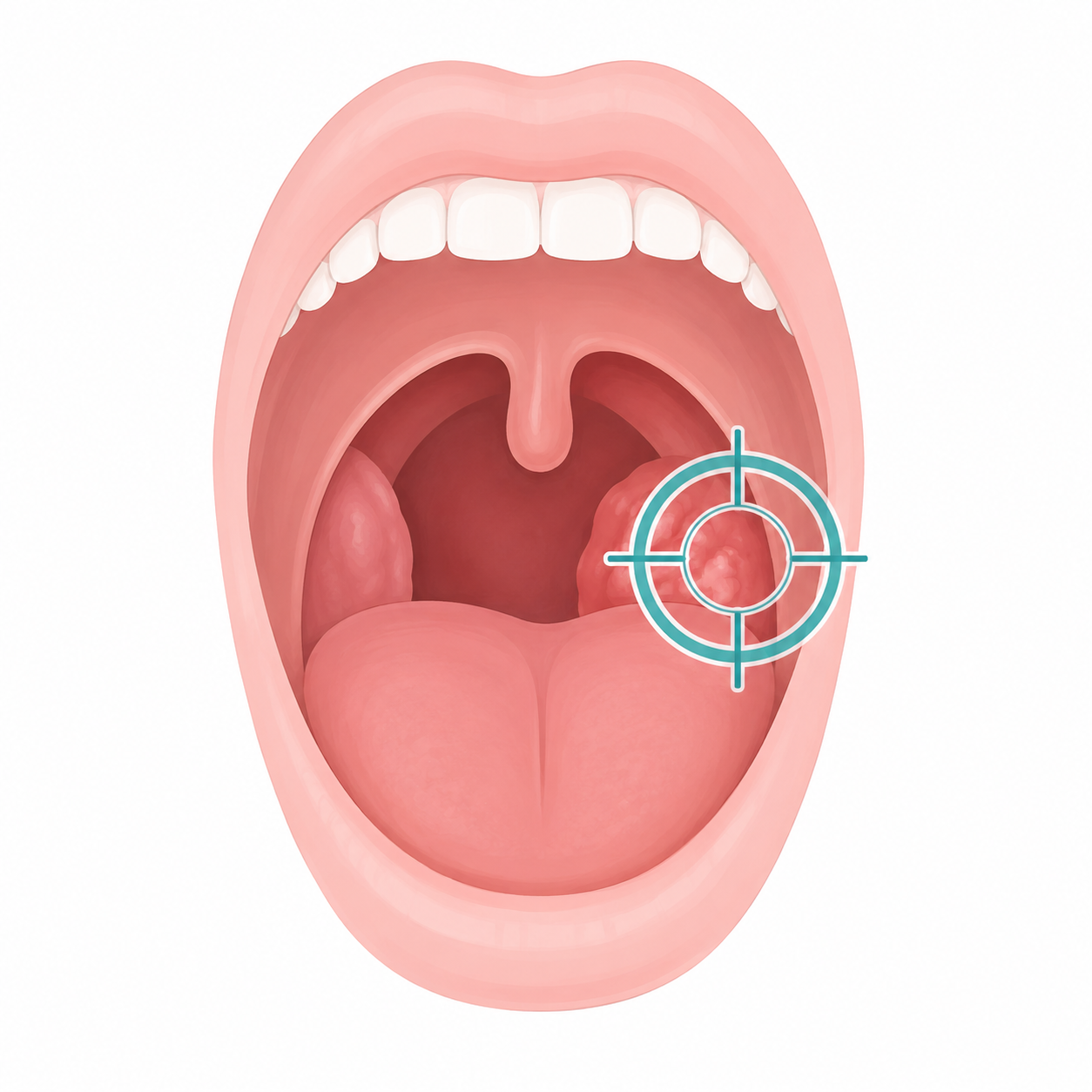Chirurgie ORL oropharyngectomie cancer oropharynx 1