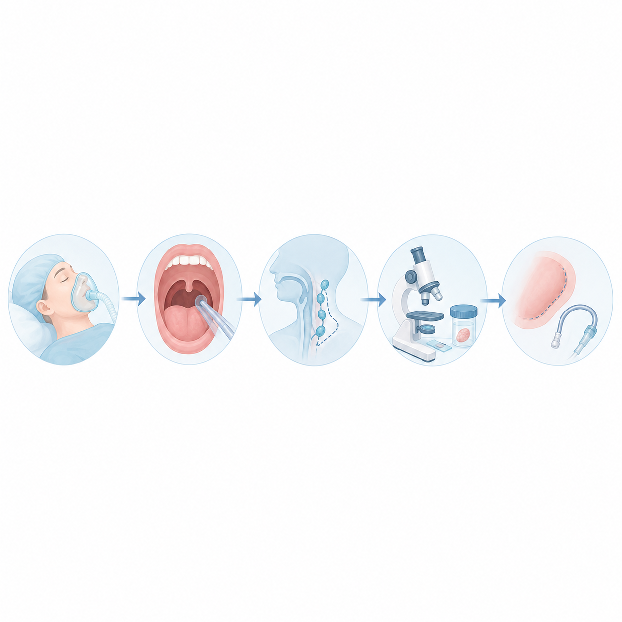 Les grandes étapes de l’intervention Chirurgie ORL oropharyngectomie cancer oropharynx