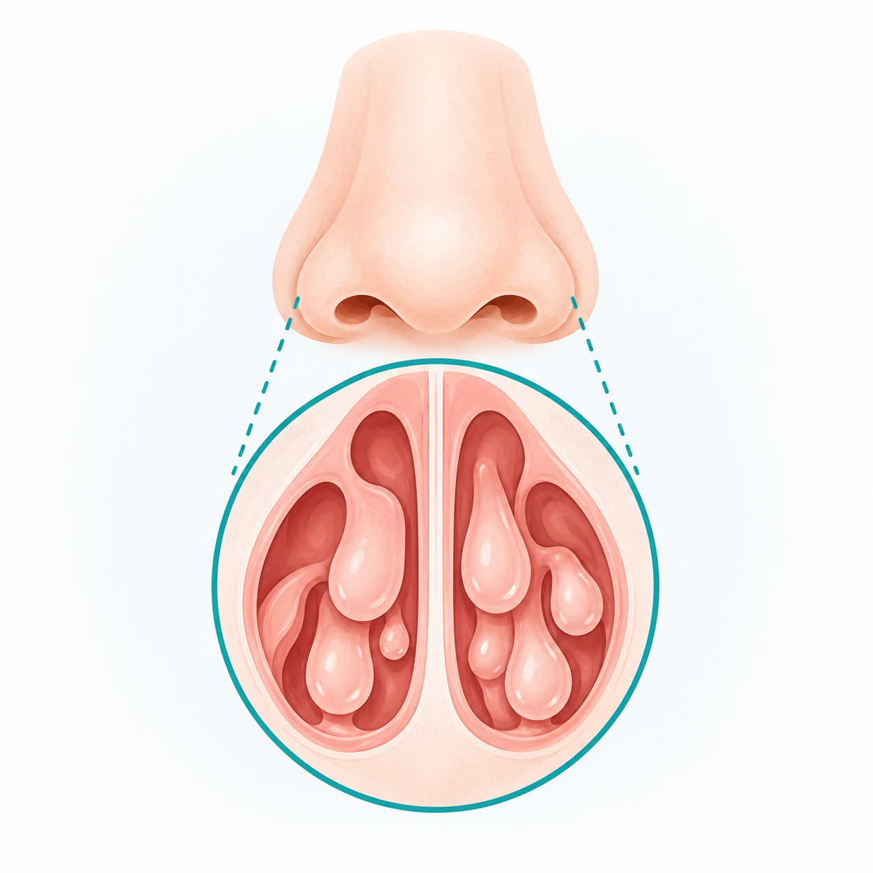 Chirurgie Rhinologie polypectomie nasale1
