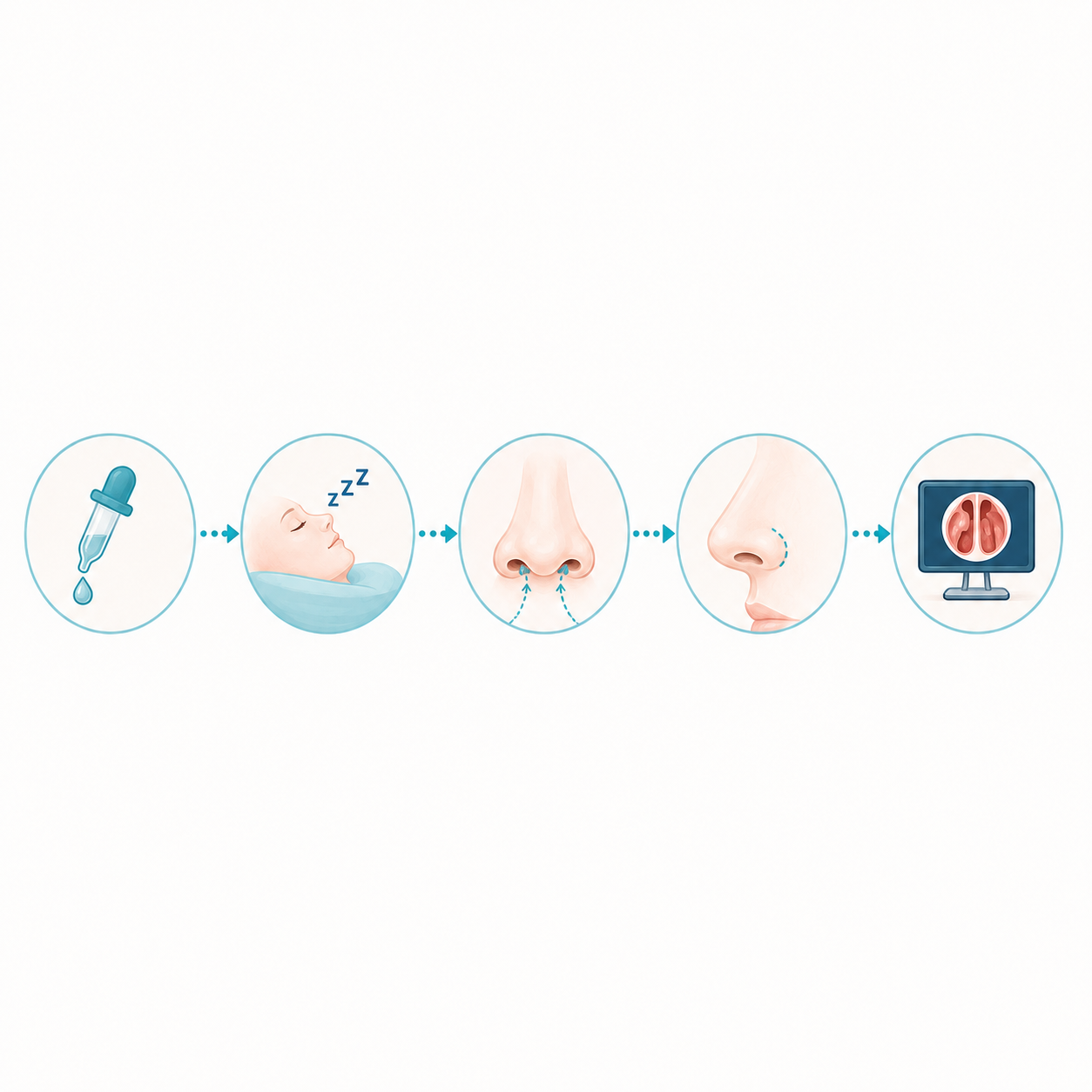 Les grandes étapes de l’intervention Comment se déroule une polypectomie nasale ?
