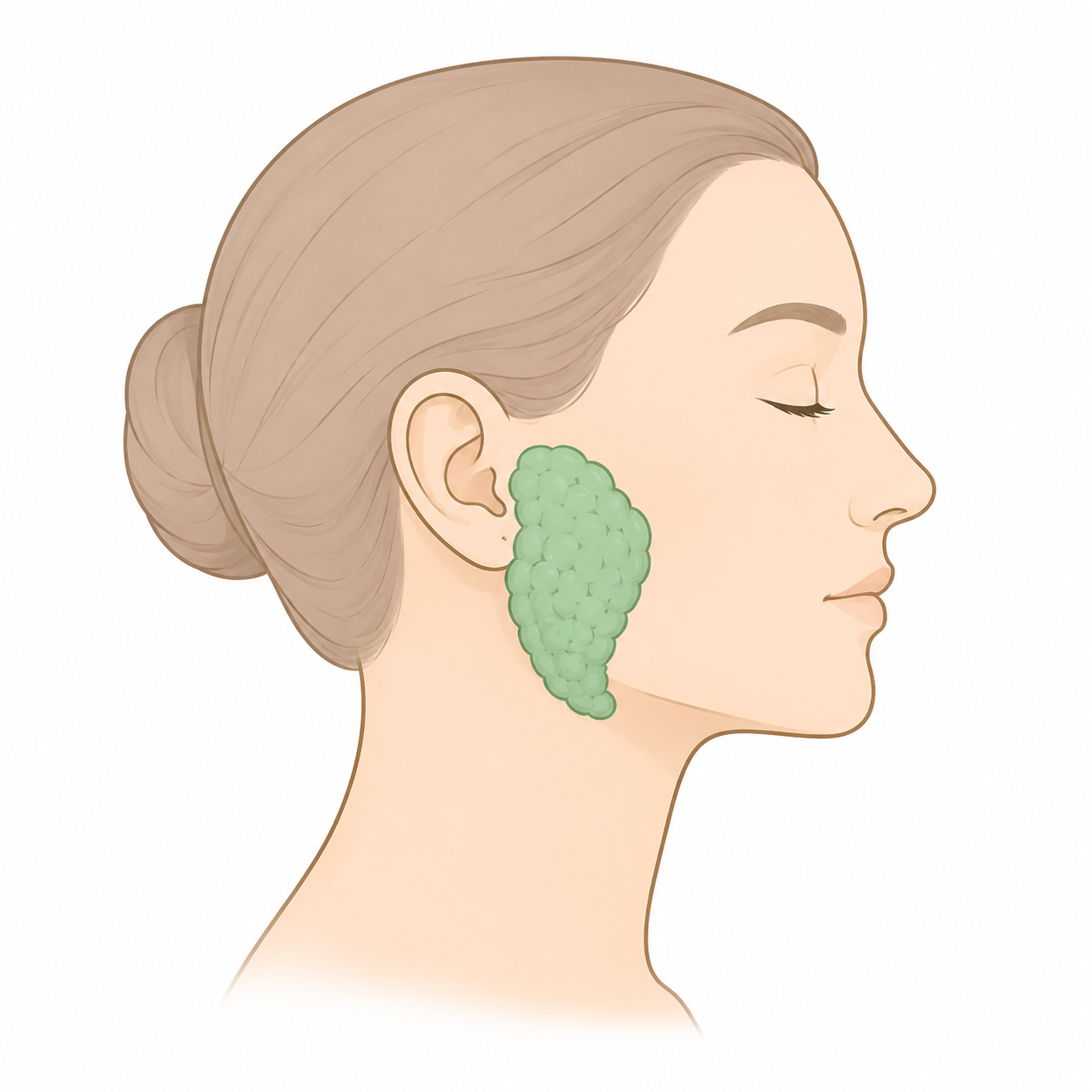 Chirurgie cervicale Parotidectomie1