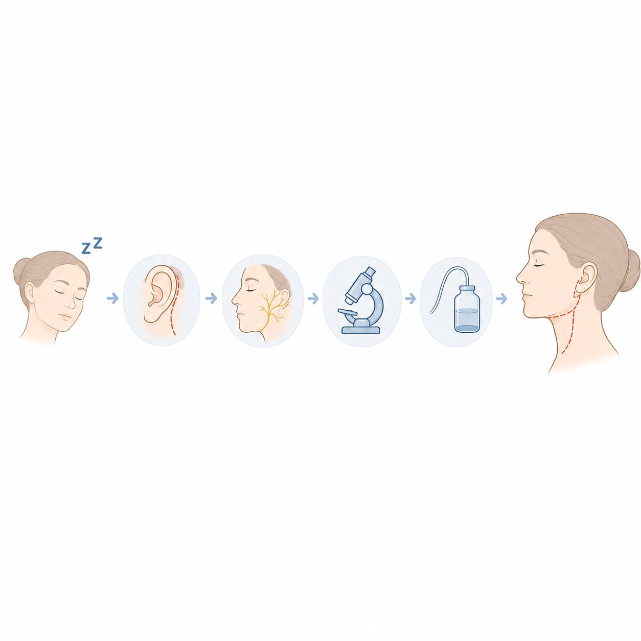 Chirurgie cervicale Parotidectomie4