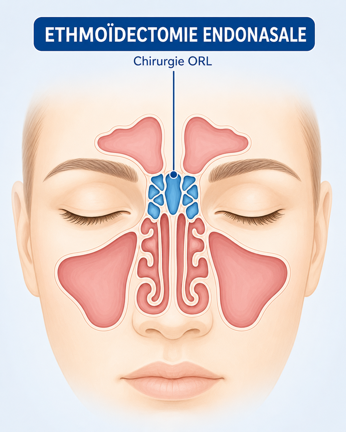 Ethmoidectomie endonasale chirurgie ORL