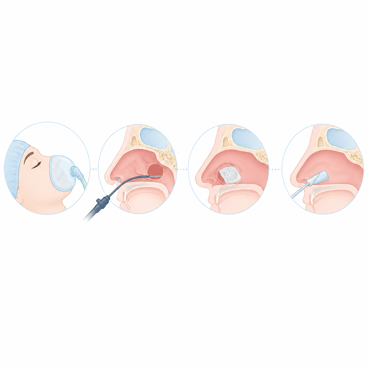 chirurgie Fermeture d'une brèche ostéo-méningée