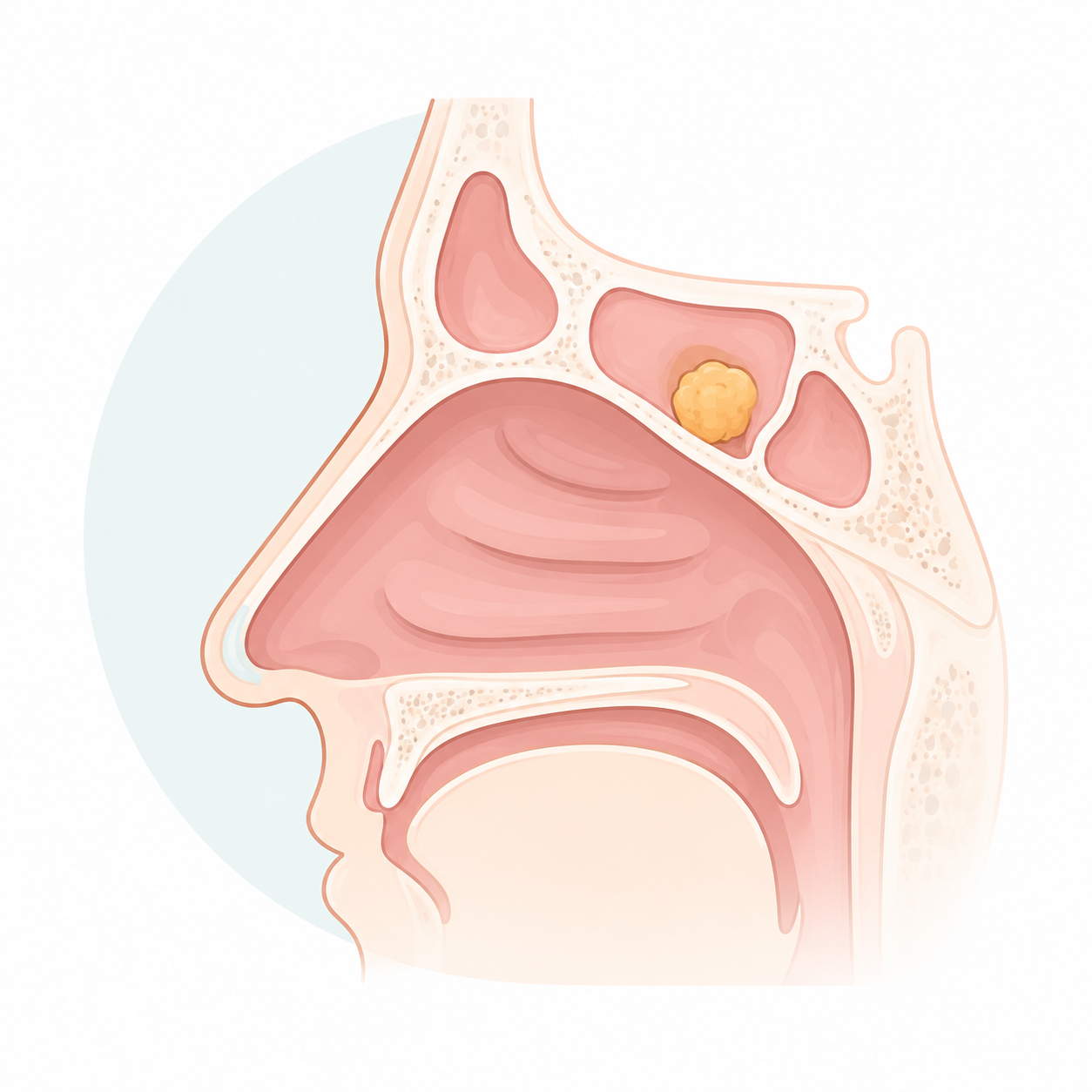 chirurgie nez Exérèse d'une tumeur du nez sinus par voie endoscopique