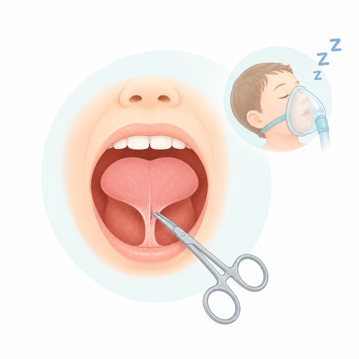 chirurgie pediatrique frénectomie linguale chez l’enfant