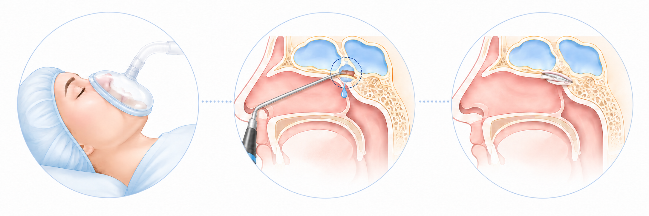 chirurgie-ORL-Fermeture-dune-breche-osteo-meningee