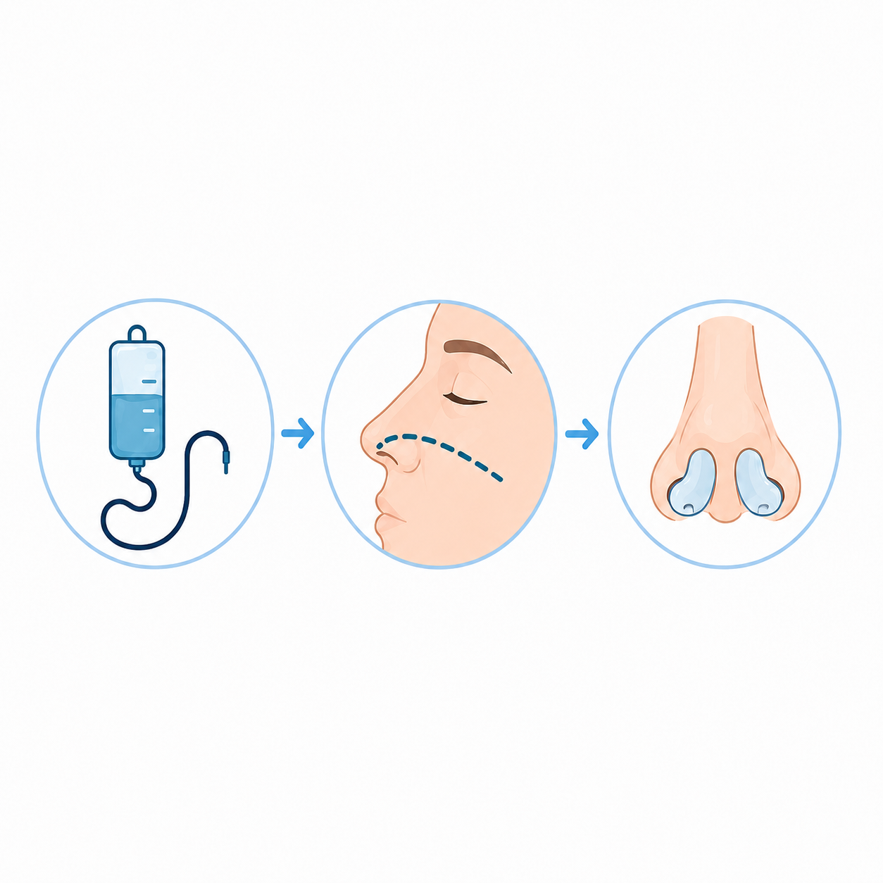 Comment se déroule l’exérèse d’une tumeur du nez ou des sinus